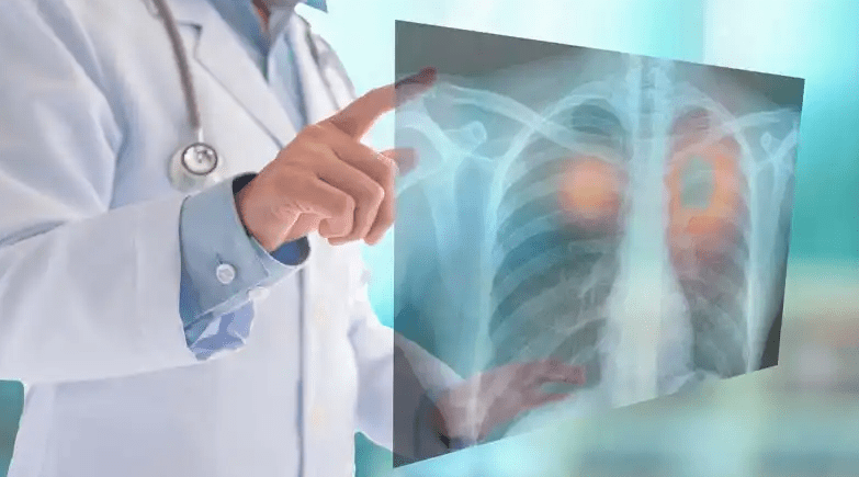 Jornada comunitaria para concientizar sobre el cáncer de&nbsp;pulmón