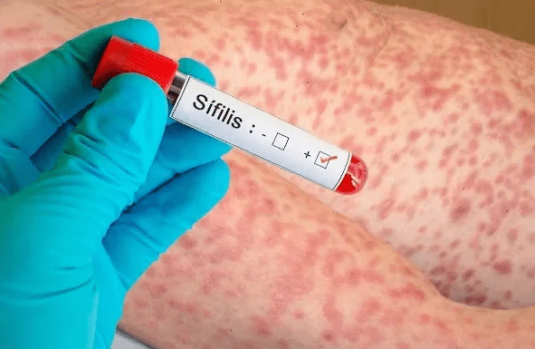 Alarma por la sífilis: los contagios crecieron 20,5% en&nbsp;Argentina