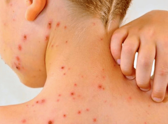 Sarampión: no aparecieron nuevos casos y se garantizó el suministro de&nbsp;vacunas