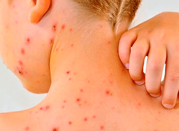 Confirman un caso de sarampión y se declara una alerta&nbsp;epidemiológica