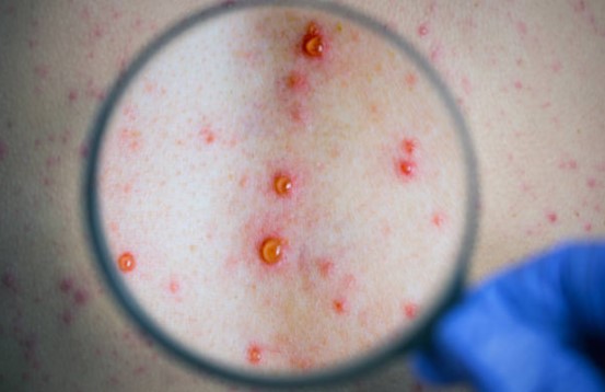 Alerta por sífilis: en 2025 se registraron más de 46.000&nbsp;casos