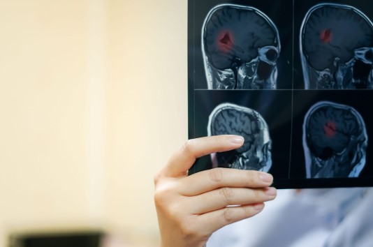 Llega al país una nueva terapia para gliomas tras más de 20&nbsp;años