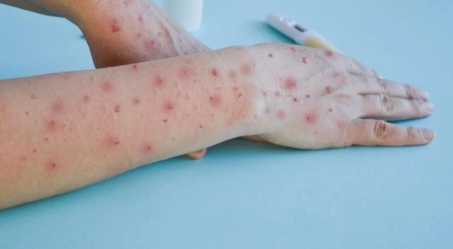 Se confirmó un nuevo caso de Mpox: qué es y cómo se&nbsp;transmite