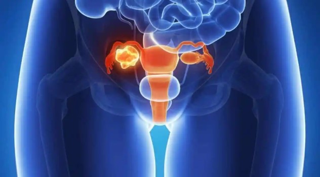 Advierten por las demoras en la detección y el tratamiento del cáncer de&nbsp;ovario