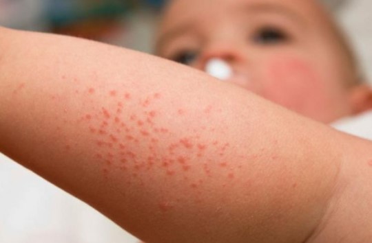 Campaña gratuita de detección de dermatitis atópica: cómo&nbsp;funciona
