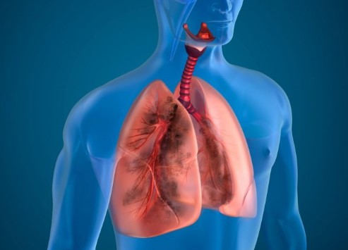 Tuberculosis: preocupación por el aumento de casos en Argentina 