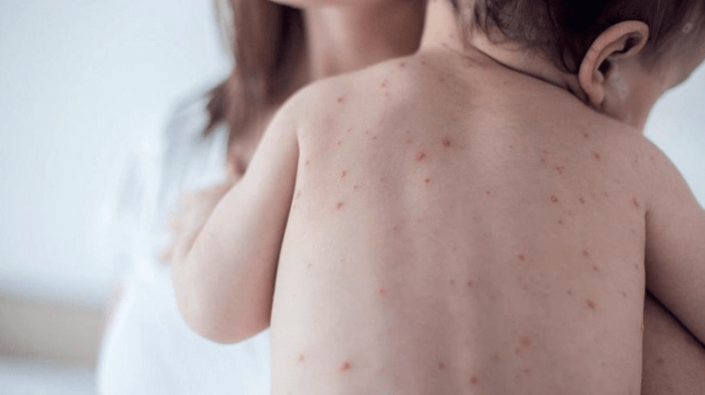 Preocupa el ingreso de casos de sarampión por el regreso del Mundial 