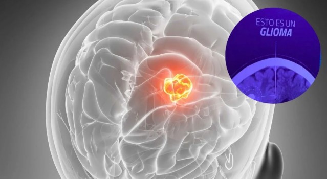 Glioma: quiénes pueden padecerlo y cuáles son sus tratamientos 