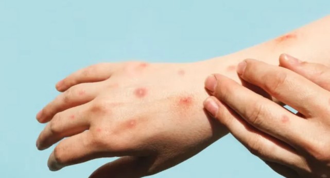 Mpox: ya son 15 los casos confirmados en Argentina durante&nbsp;2026